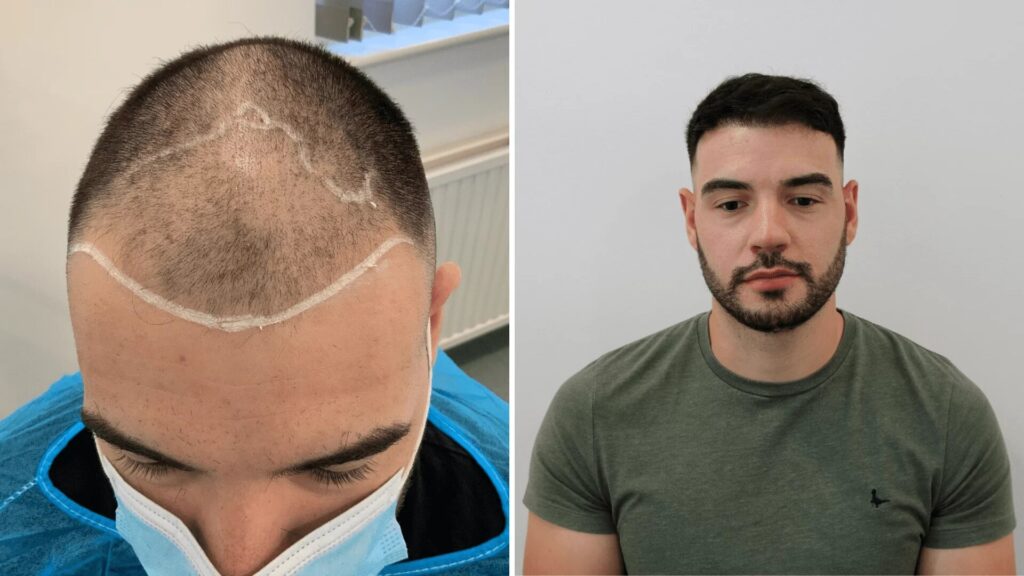 Hair transplant London