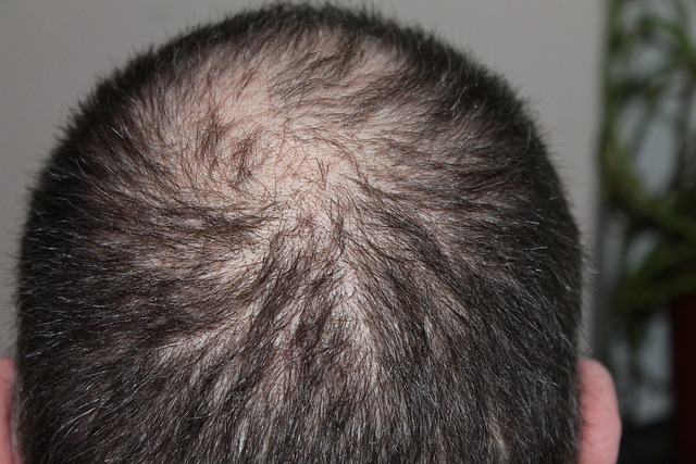 Hair transplant London